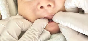 Closeup of two fingers in white gloves opening a baby's mouth