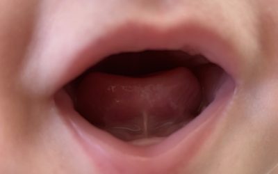 What is a Tongue Tie and Frenotomy procedure?